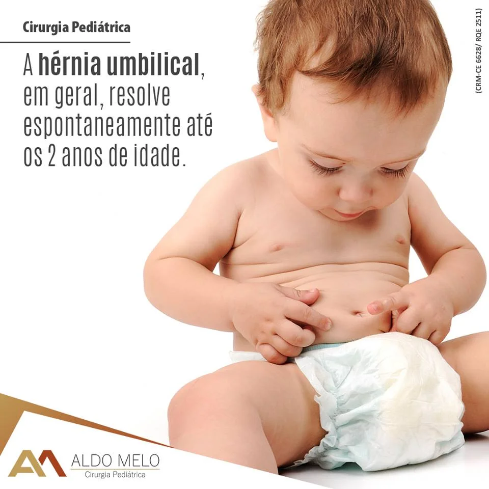 Hérnia umbilical em crianças - Dr. Aldo Melo- Cirurgia Pediátrica