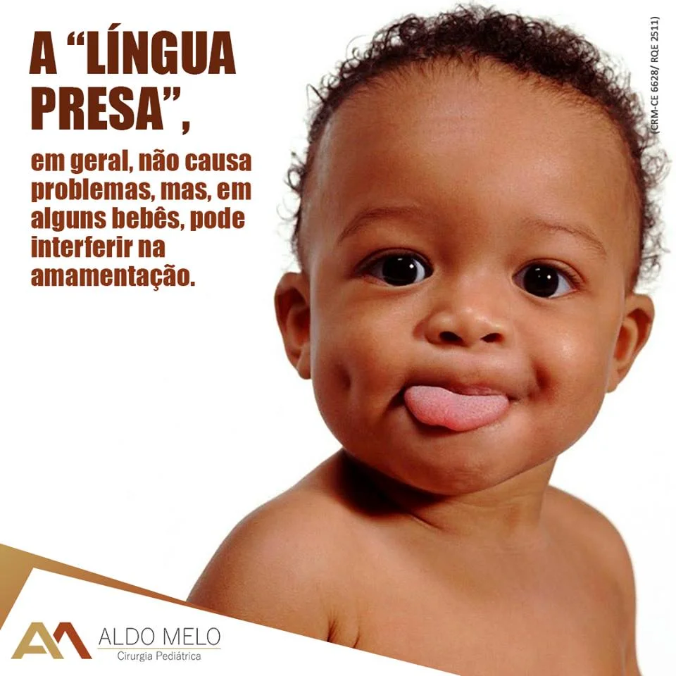 Anquiloglossia ou "lingua presa" - Dr. Aldo Melo