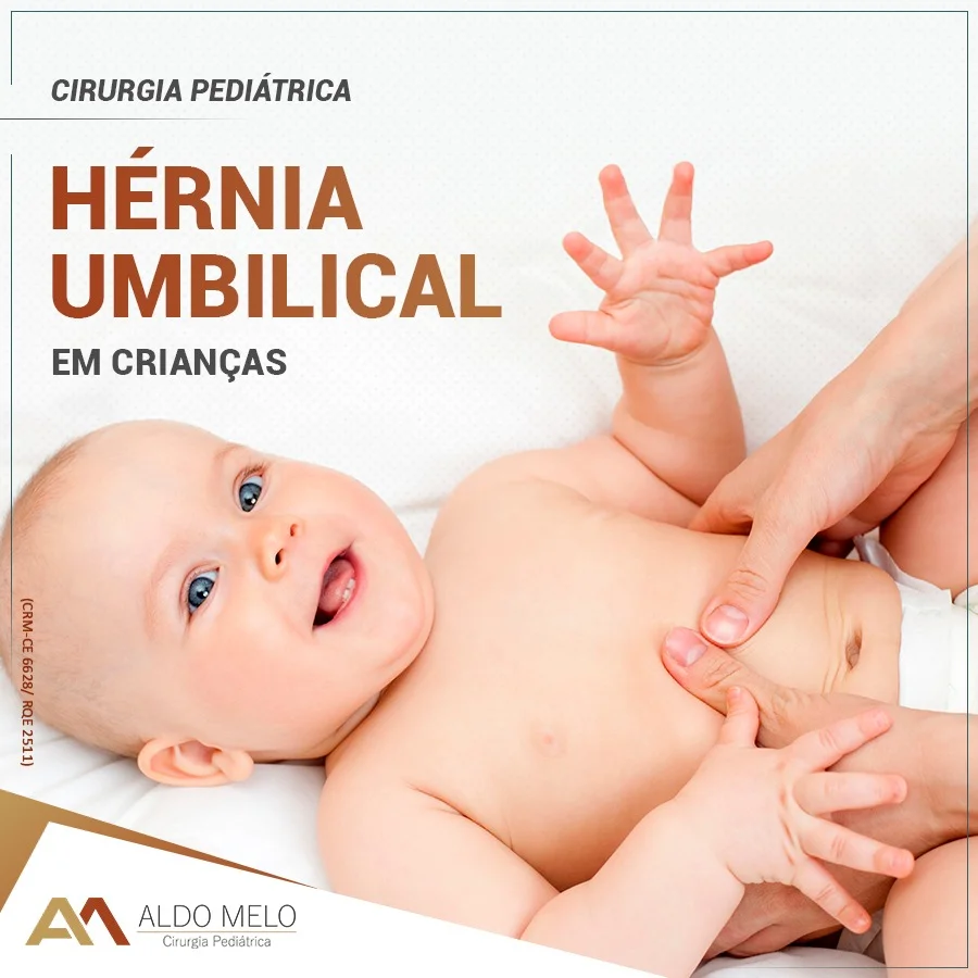 Hérnia umbilical em crianças - Dr. Aldo Melo - Cirurgia Pediátrica